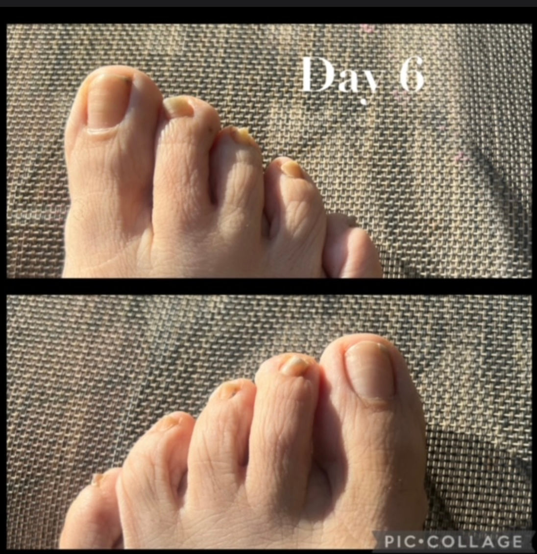 Toe Foot Fungus Natural Spray